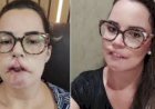 Influenciadora digital sofre complicações após harmonização facial com substância não absorvível