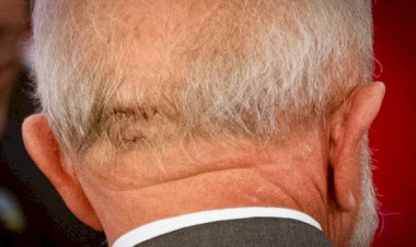 Lula Passa por Cirurgia de Emergência para Tratar Hemorragia Intracraniana