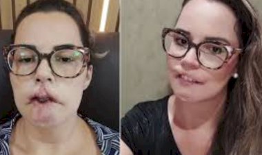 Influenciadora digital sofre complicações após harmonização facial com substância não absorvível