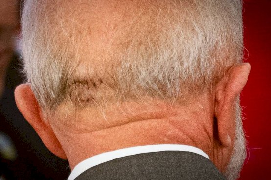 Lula Passa por Cirurgia de Emergência para Tratar Hemorragia Intracraniana